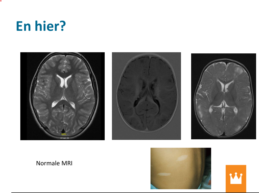 braindev-MRI-normal