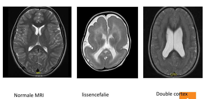 braindev-MRI-rare